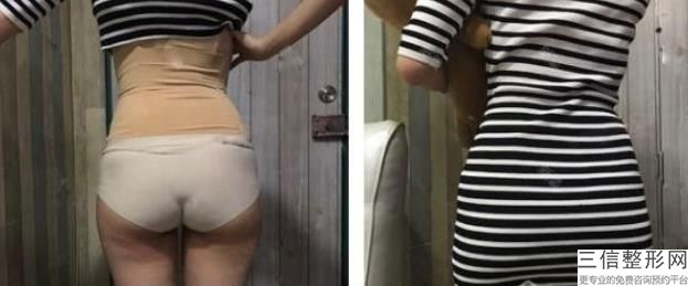 玻尿酸丰胸一次比较多打多少针(玻尿酸丰胸一次比较多打多少针呢)