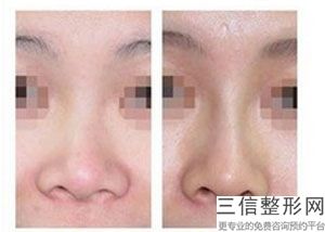 玻尿酸隆鼻好不好(玻尿酸隆鼻什么牌子效果好)