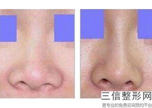 超肋骨隆鼻可以维持一辈子吗多久(超肋骨隆鼻可以维持一辈子吗多久恢复)