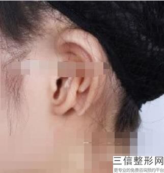 成人招风耳矫正需要多久(成人招风耳矫正需要多久时间)