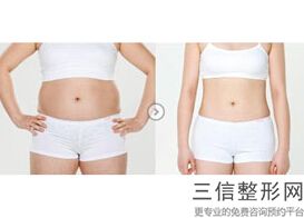 抽脂丰胸和假体哪个更好点呢(抽脂丰胸和假体哪个更好点呢视频)