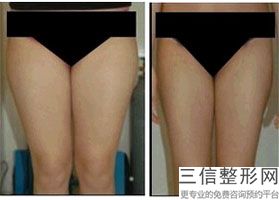 抽脂丰胸价格一览表