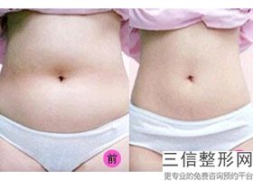大腿抽脂的坏处(大腿抽脂的坏处加提臀)