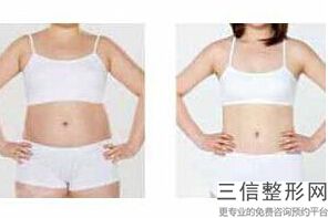 大腿抽脂填充脸部(大腿抽脂填充脸部要穿多久塑身裤)