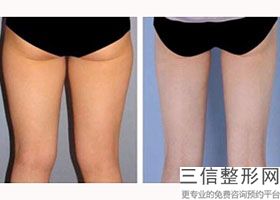 大腿抽脂填充全脸大腿酸痛(大腿抽脂填充全脸大腿酸痛正常吗)