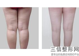 大腿抽脂效果明显吗(大腿抽脂效果明显吗图片)