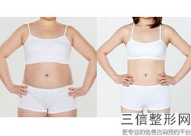 大腿抽脂有什么危害(大腿抽脂有什么危害和后遗症)