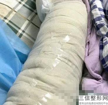 大腿环吸多久可以侧睡(大腿环吸多久可以侧躺)