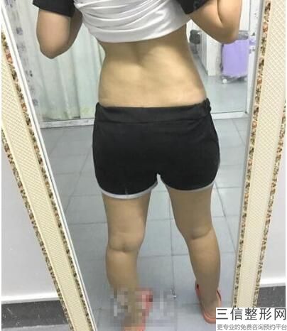 大腿环吸多久有效果(大腿环吸多久有效果正常)