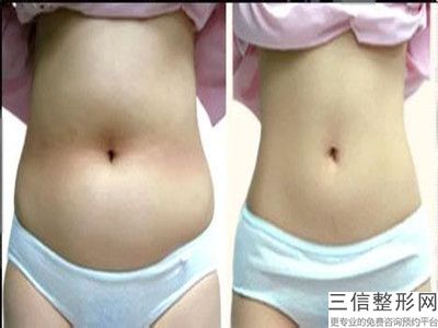 大腿环吸需要吃消肿药吗(大腿环吸需要吃消肿药吗多久)