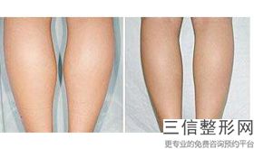 大腿吸脂多久可以消肿掉啊女生(大腿吸脂多久可以消肿掉啊女生图片)