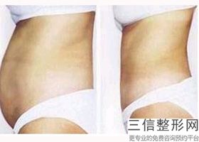 大腿吸脂会反弹吗多久消肿(大腿吸脂会反弹吗多久消肿正常)