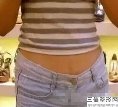 大腿吸脂有什么风险(大腿吸脂有什么风险和后遗症)