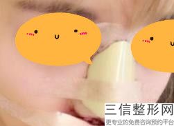 非常好次注射玻尿酸隆鼻能维持多久(非常好次注射玻尿酸隆鼻能维持多久呢)
