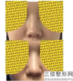 垫鼻子用什么骨架好看(垫鼻子用什么骨架好看图片)