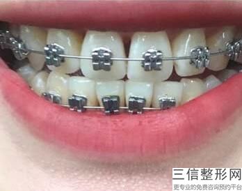 儿童矫正牙齿可以用医保吗(儿童矫正牙齿可以用医保吗报销吗)