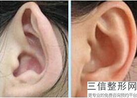 耳软骨隆鼻和肋骨隆鼻哪个效果好(耳软骨隆鼻和肋骨隆鼻哪个效果好些)