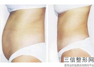 丰胸隆胸需要多少钱(进口曼托隆胸多少价格)
