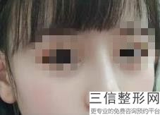 硅胶假体隆鼻价格多少(硅胶假体隆鼻价格多少钱)