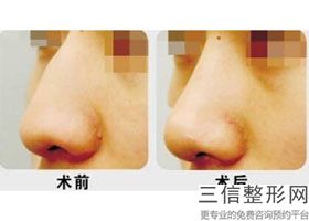 硅胶隆鼻能用多久(硅胶隆鼻能用多久)