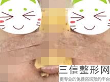 硅胶隆鼻有什么坏处嘛(硅胶隆鼻有什么坏处嘛图片)