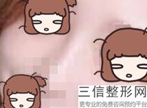 假体隆鼻的风险大吗(假体隆鼻的风险大吗知乎)