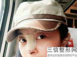 假体隆鼻多久可以化妆洗脸(假体隆鼻多久可以化妆洗脸护肤)