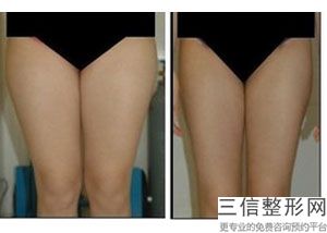 假体隆胸要怎么按摩才会变软(假体隆胸要怎么按摩才会变软呢)