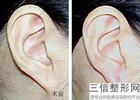 矫正招风耳土方法如下(矫正招风耳小妙招)
