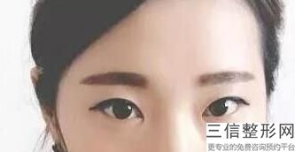 开眼角整形手术(开眼角整形手术价格)