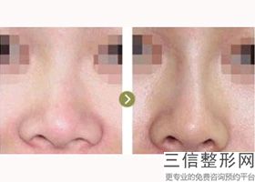 肋骨隆鼻会留疤痕吗(肋骨隆鼻会留疤痕吗图片)