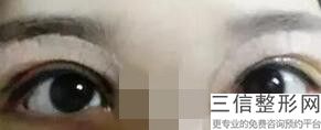 埋线双眼皮现在大概多少钱(埋线双眼皮现在大概多少钱一次)