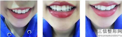 美容院做的牙齿贴面是怎样做的(美容院做的牙齿贴面是怎样做的呢)