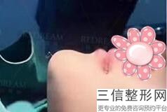 哪种玻尿酸丰唇效果好(哪种玻尿酸丰唇效果好一点)