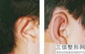 膨体加耳软骨隆鼻安全吗(膨体加耳软骨隆鼻安全吗多少钱)