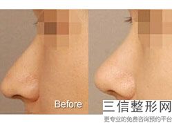 膨体隆鼻和硅胶隆鼻哪个好(膨体隆鼻和硅胶隆鼻哪个好一点)
