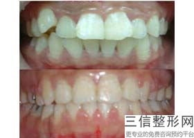 舌侧矫正怎么刷牙(舌侧矫正怎么刷牙视频)