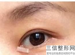 双眼皮修复大约多少钱