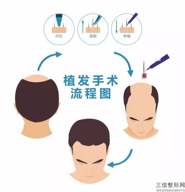 无痕植发的价格贵吗(无痕植发的价格贵吗多少钱)