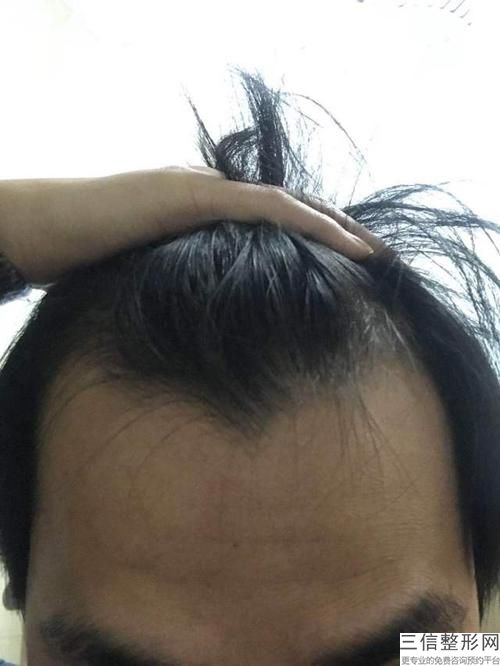 现在植发要多少钱(植发3500单位效果图)