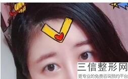 想做埋线双眼皮多少钱(想做埋线双眼皮多少钱一次)