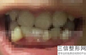 牙齿贴面修复(牙齿贴面修复多少钱)