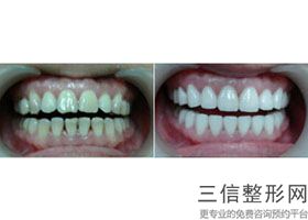 牙齿正畸是为了什么(牙齿正畸是为了什么呢)