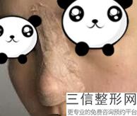 一般做个鼻综合多少钱(一般做个鼻综合多少钱一次)