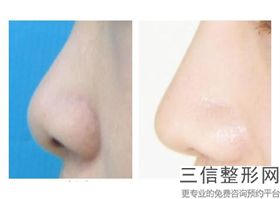 异体肋骨隆鼻是长久的吗(异体肋骨隆鼻是长久的吗)