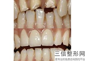 隐形矫正牙和普通矫牙效果一样吗(隐形矫正牙和普通矫牙效果一样吗图片)