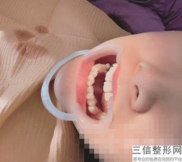隐形矫正要多久(隐形矫正牙齿一般要多久)