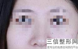 用男朋友的肋骨垫鼻子(用男朋友的肋骨垫鼻子可以吗)