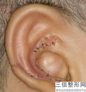 怎么矫正招风耳(怎么矫正招风耳发型)