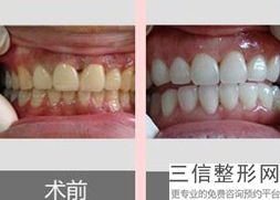 正畸牙齿拔牙好不好拔(正畸牙齿拔牙好不好拔呢)